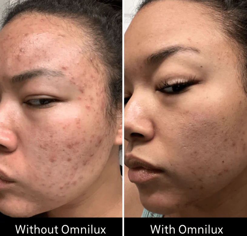 Omnilux Clear - Image 10