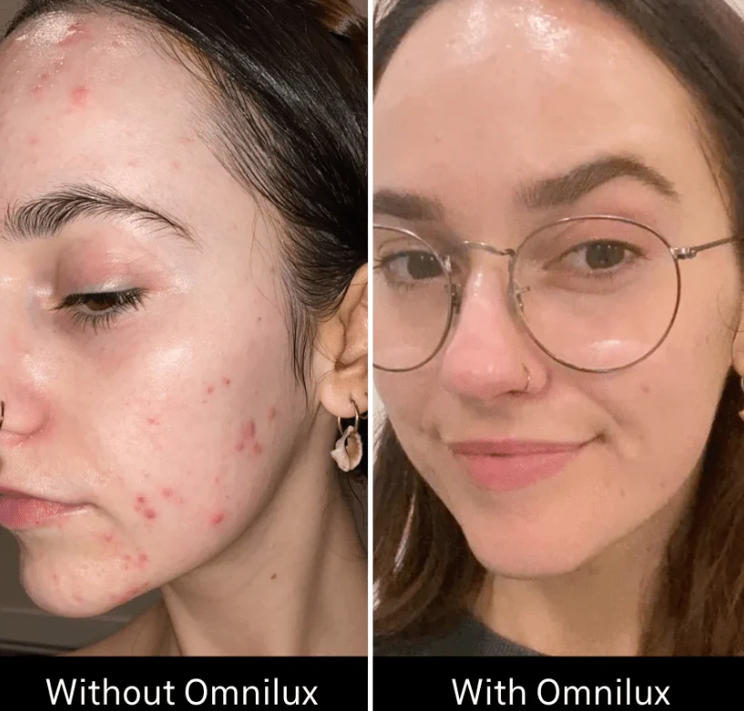 Omnilux Clear - Image 11