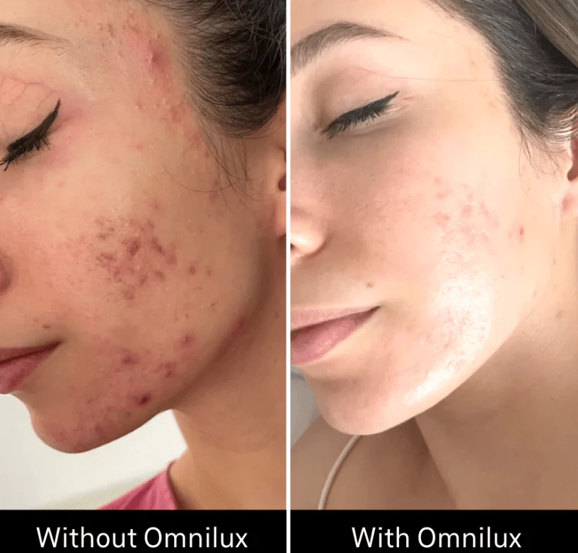 Omnilux Clear - Image 12