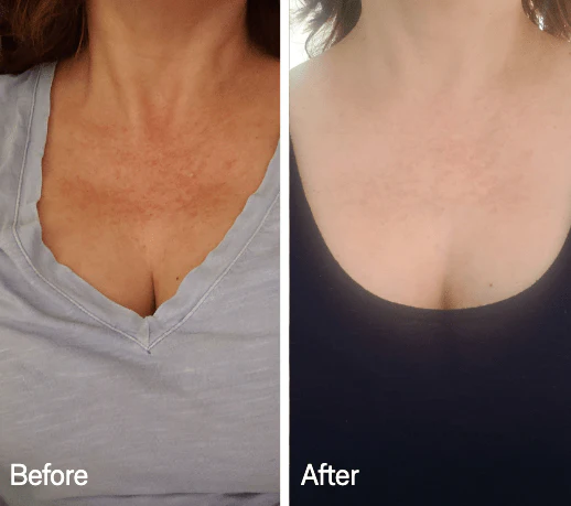 Omnilux Contour Neck & Décolleté - Image 5