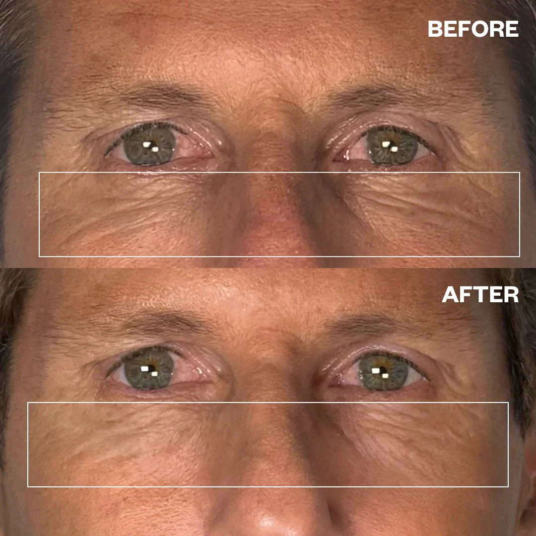 Wrinkles Schminkles Men's Pro Eye Wrinkle Patches - 3 Pairs - Image 2